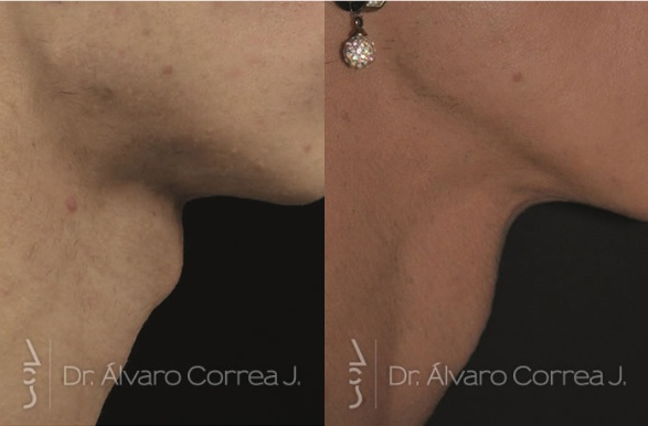Plastia del cartílago tiroides: qué corrige