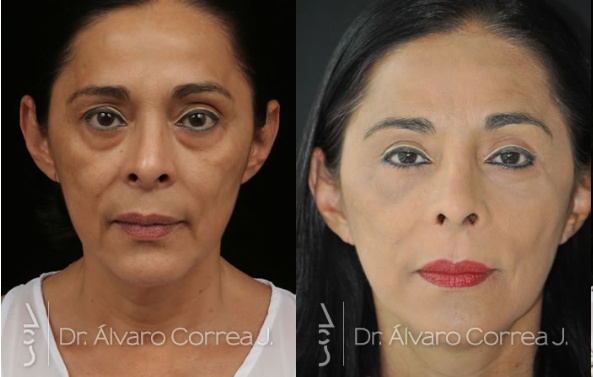 Blefaroplastia para párpados caídos