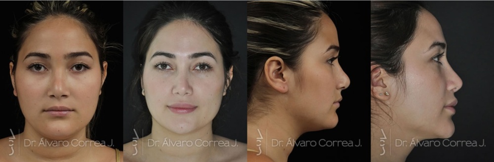 Caso real de rinoplastia secundaria y corrección