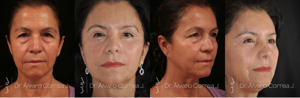 Ejemplo de rejuvenecimiento facial quirúrgico real