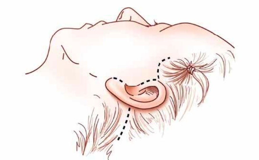 Cómo cuidar cicatrices de ritidoplastia