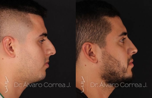 Cómo lograr un resultado natural en rinoplastia masculina