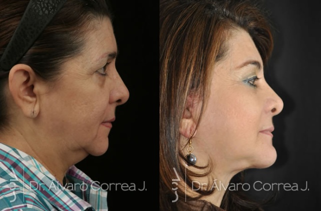Opciones para mentón retraído y perfil facial