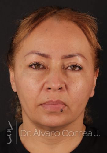 Rinoplastia Refinamiento Nasal, Frontoplastia, Frontoplastia Reducción - Medellin, Colombia