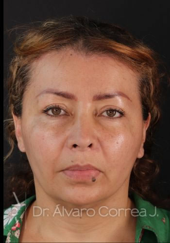 Rinoplastia Refinamiento Nasal, Frontoplastia, Frontoplastia Reducción - Medellin, Colombia