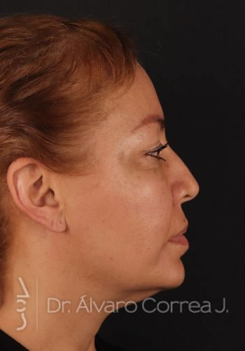 Rinoplastia Refinamiento Nasal, Frontoplastia, Frontoplastia Reducción - Medellin, Colombia