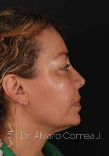 Rinoplastia Refinamiento Nasal, Frontoplastia, Frontoplastia Reducción - Medellin, Colombia