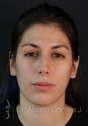 Rinoplastia Exceso de Dorso, Columela Retraida, Implante paranasal - Medellin, Colombia