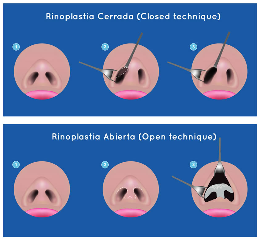 ¿Cuáles son las diferencias entre rinoplastia abierta o cerrada?