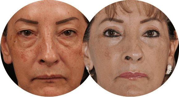 Blefaroplastia - Medellin, Colombia - Dr. Alvaro Correa J